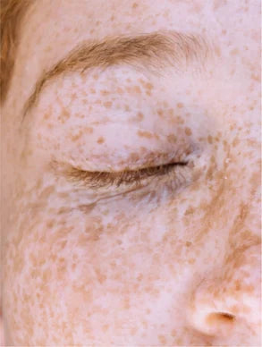 Dark Spot Face Cream with Kojic Acid